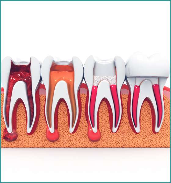 Root Canal Treatment (5)