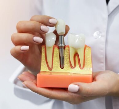 Dental Implant in Punjabi Bagh