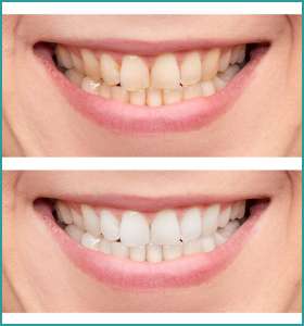 Best zoom teeth whitening clinic in South Delhi