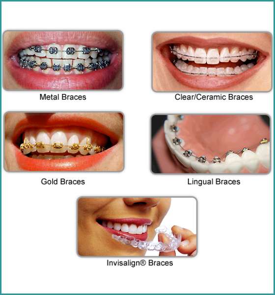 Braces treatment in South delhi