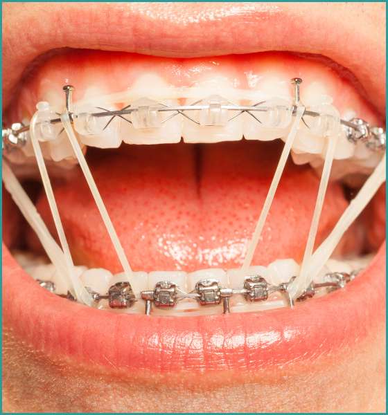 Orthodontics in vasant vihar