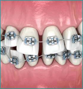 Braces treatment in south delhi