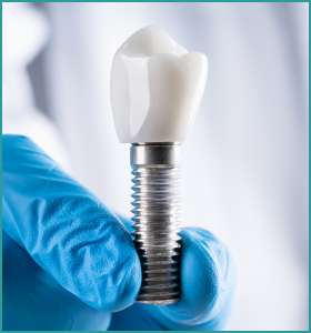 dental implants provider in south delhi