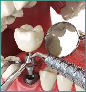 dental implants surgery in delhi