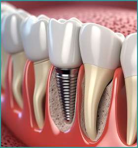 Dental Implants in South Delhi