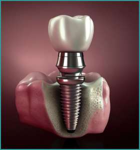 dental implant recommendation for patients