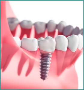 how does dental implants work?