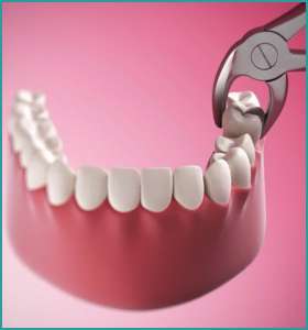 Wisdom tooth extraction in vasant vihar