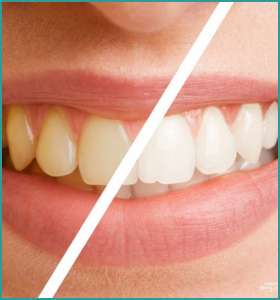 Teeth whitening in south delhi