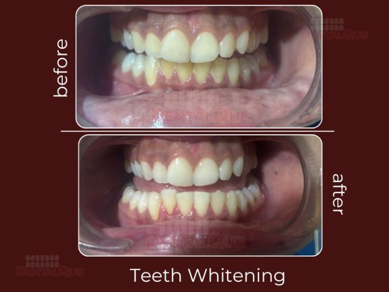 Teeth Whitening in Punjabi Bagh