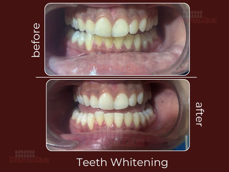 Teeth Whitening in Punjabi Bagh