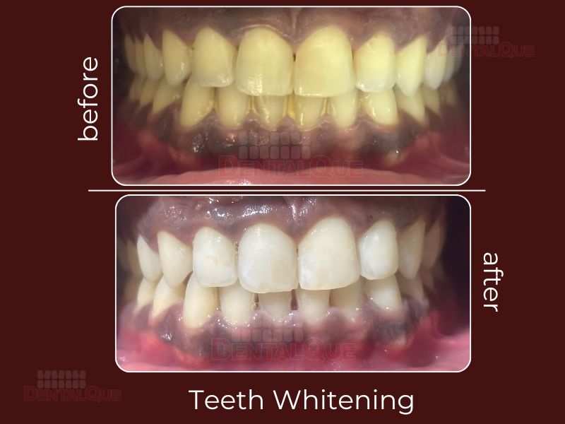 teeth whitening