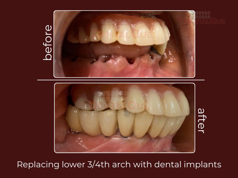 Dental Implants