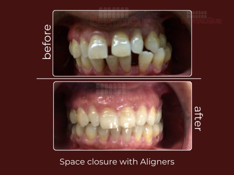 space closure with invisalign