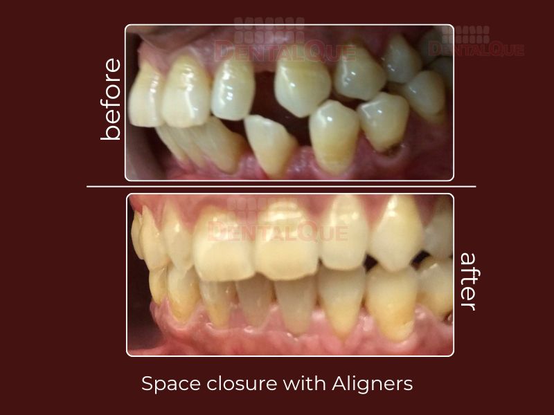 space closure with invisalign