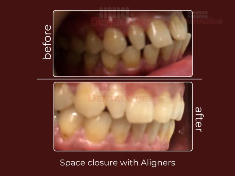 space closure with invisalign