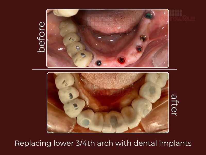 Dental Implants
