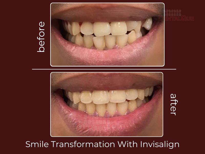 SMILE MAKEOVER