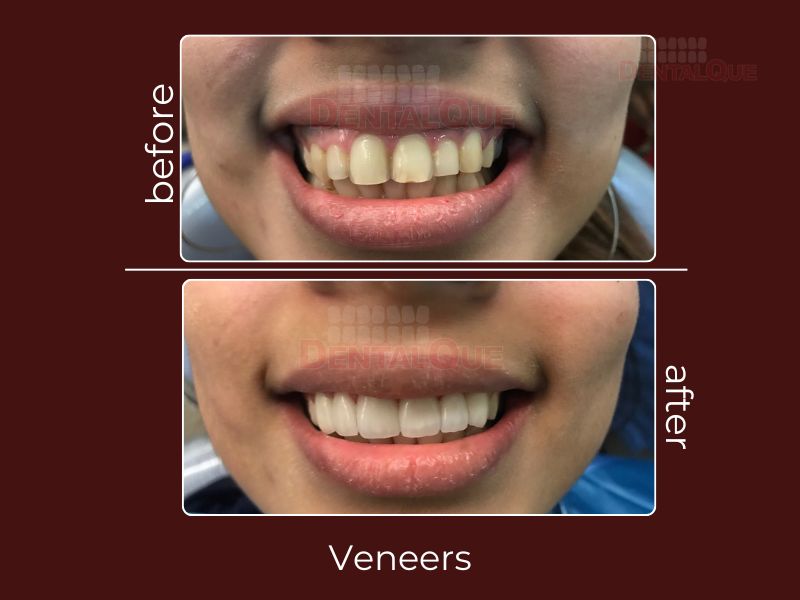 veneers in punjabi Bagh
