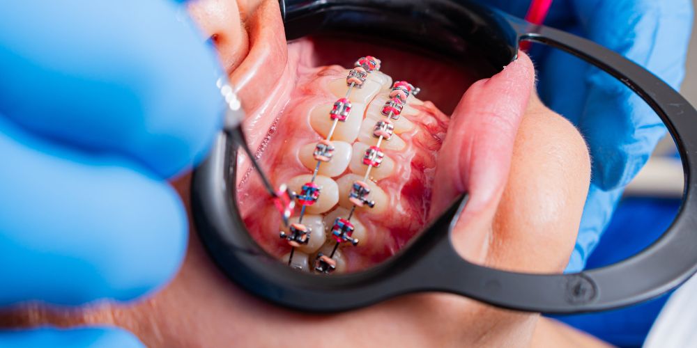 Braces treatment in Punjabi Bagh