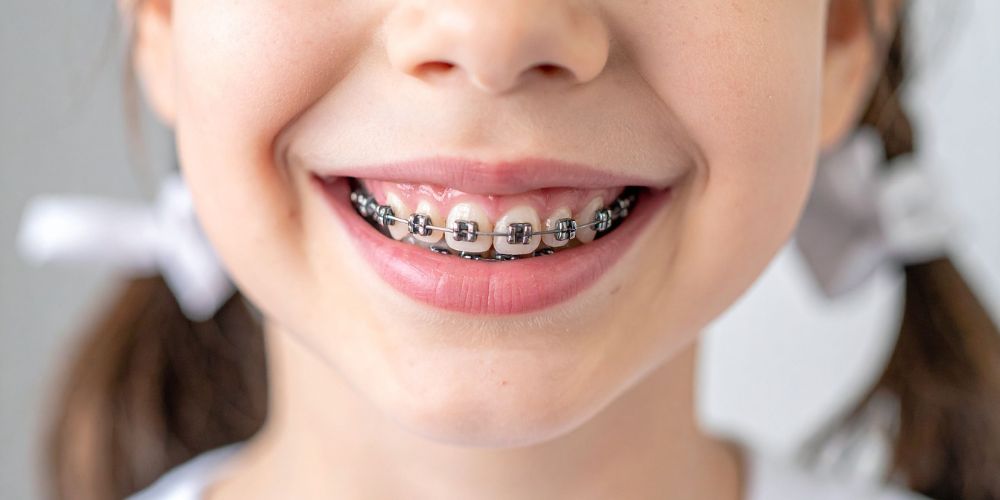 Braces treatment in Punjabi Bagh