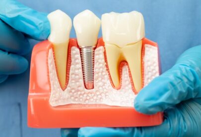 Dental Implant in Punjabi Bagh