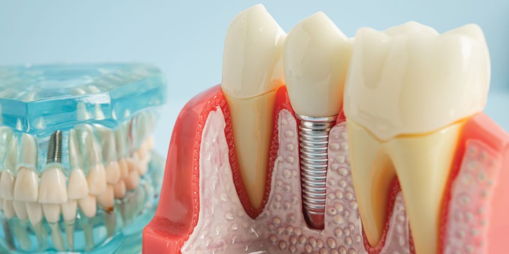 Root Canal Treatment in Punjabi Bagh