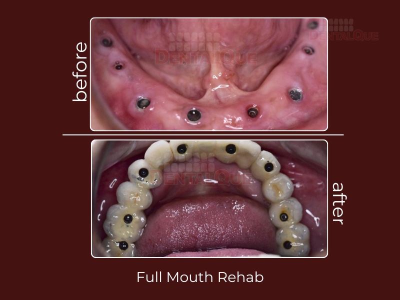 Full Mouth Rehab in Punjabi Bagh