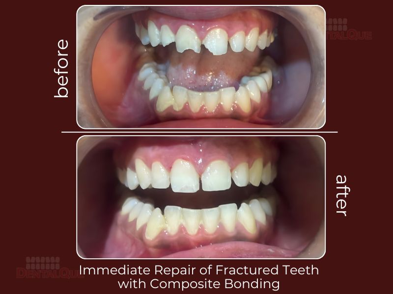 fractured Teeth treatment Punjabi Bagh