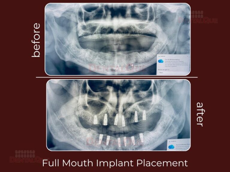 full mouth implant placement ounjabi Bagh