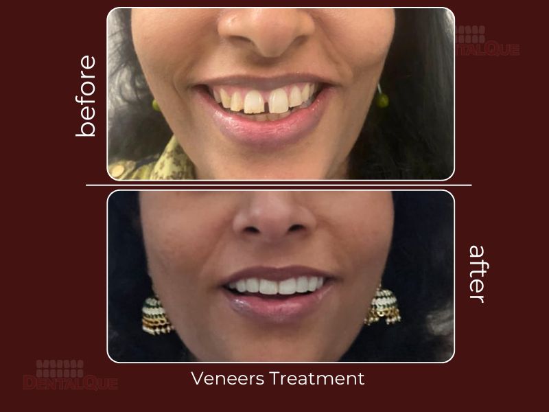 veneers punjabi bagh