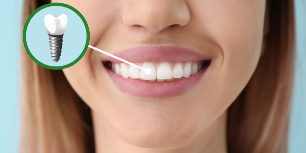 Dental Implant in Punjabi Bagh