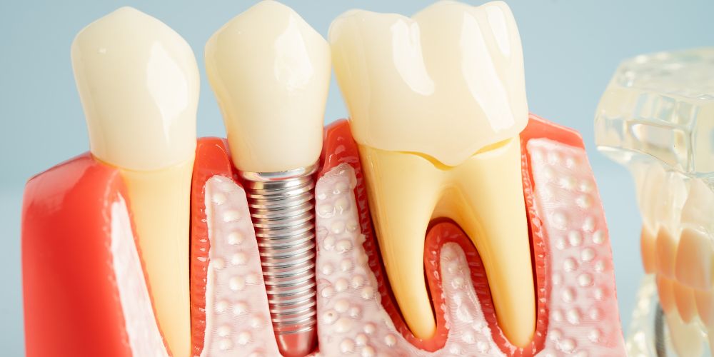 Dental Implant