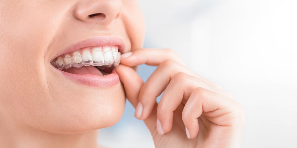 Invisalign in Punjabi Bagh