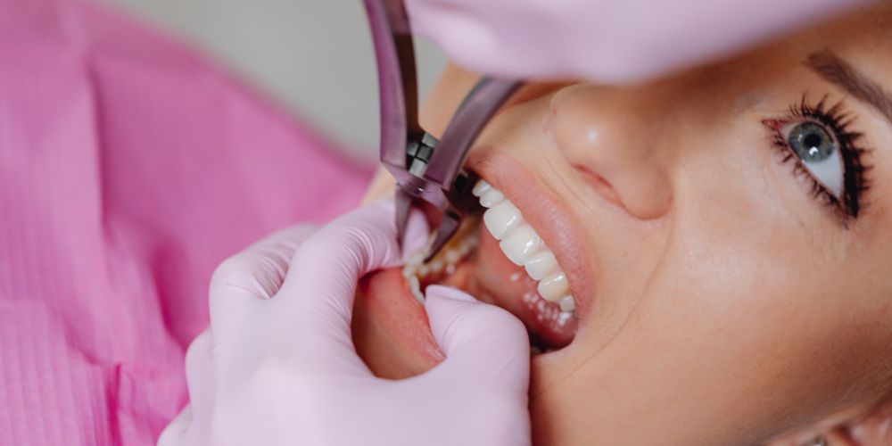 Wisdom Tooth Extraction in West Delhi