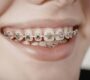 Braces 90x80