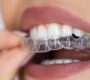 Clear Aligners 90x80