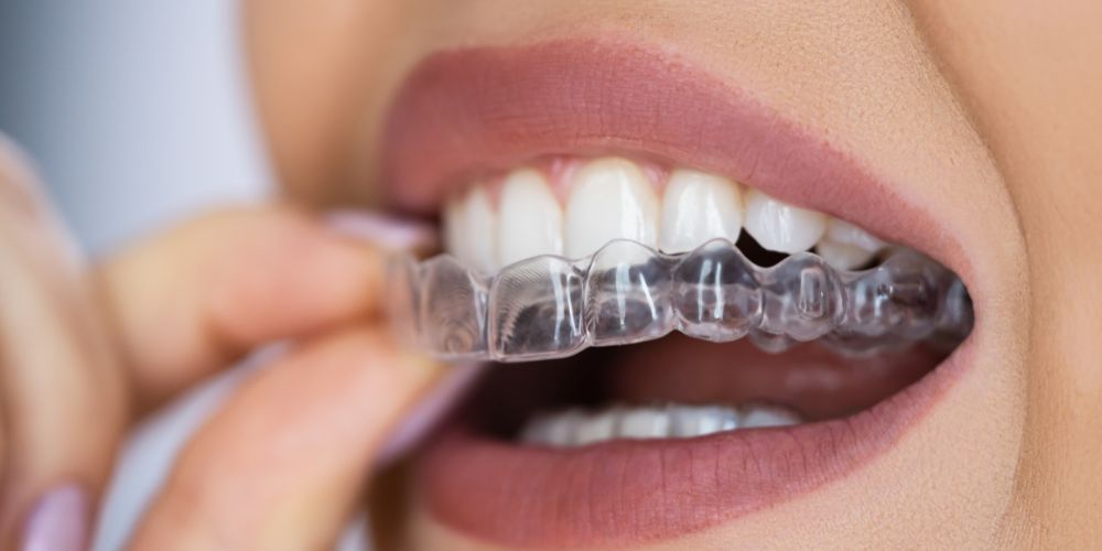 Clear Aligners