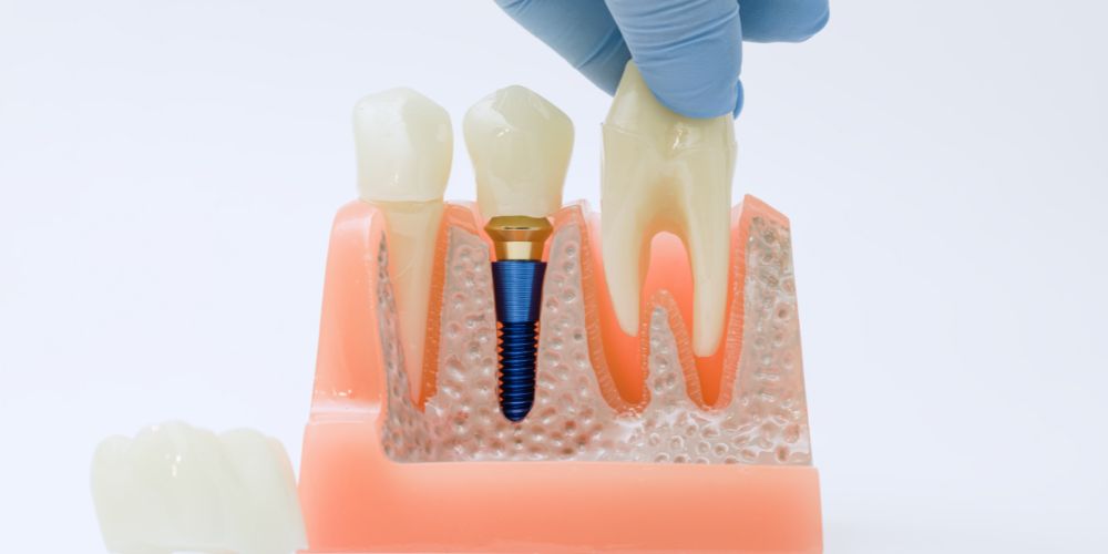 Dental Implant in Punjabi Bagh