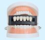 dental veneers 90x80