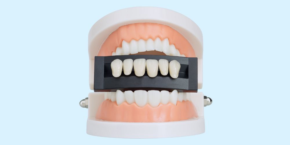 dental veneers