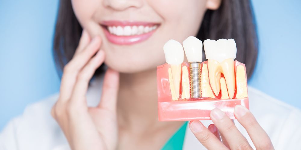 Dental Implant in Punjabi Bagh
