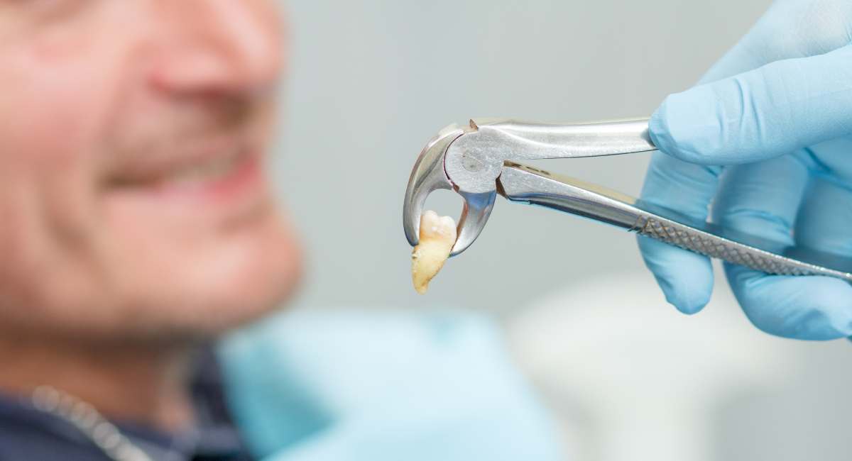 wisdom tooth extraction west delhi