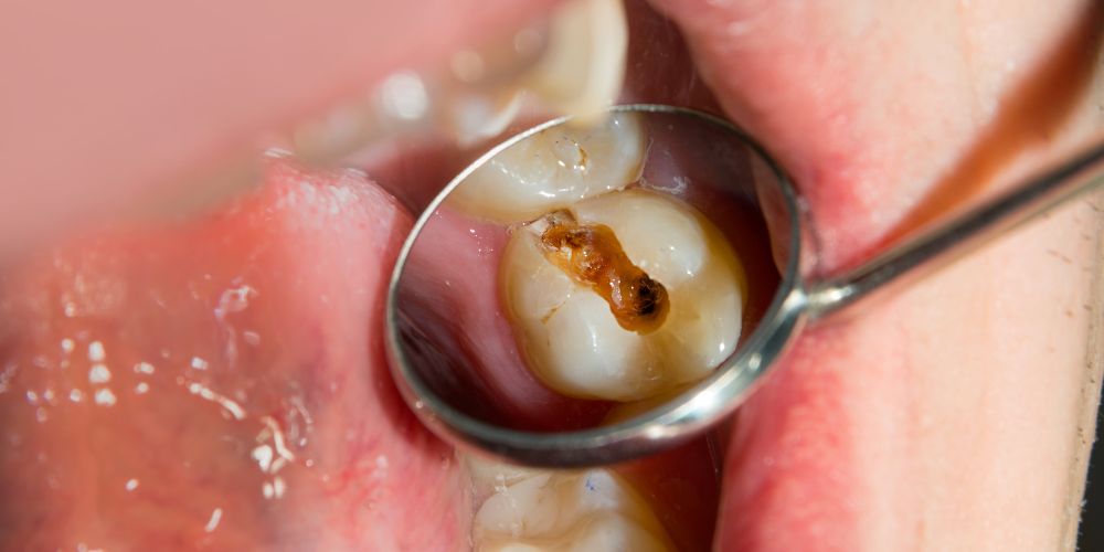 Wisdom Tooth Extraction in West Delhi