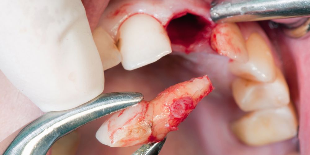 Wisdom Tooth Extraction in West Delhi