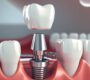 Dental Implants Treatment 90x80